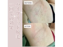 最新のハイブリッド脱毛導入！一回でこれくらい減ります^ ^