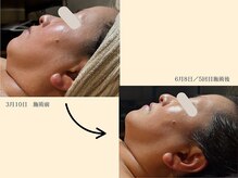パンセリーノ(Panselinos)/エイジング120分コース5回施術後