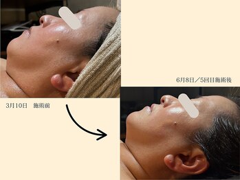 パンセリーノ(Panselinos)/エイジング120分コース5回施術後