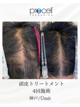 ユミト(Umit)/プロセルスカルプ