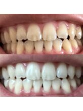 ハク 南船橋店(HAKU)/☆ホワイトニング☆事例写真６