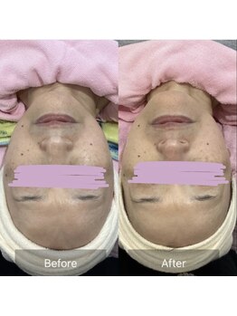 じゅえる/→続きシミケアとシワたるみケア