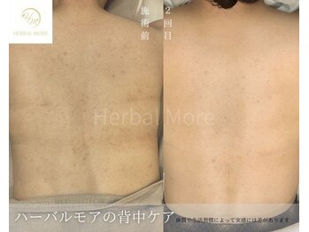 サロン ヴィーナス(VENUS)/剥けるハーブピーリング背中の例