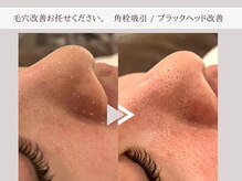 レイテノール 藤沢店の雰囲気（毛穴改善症例多数。つるピカ鼻づくり自信あります！）