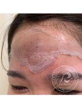 リベル 名古屋(Lebelle:)/ハーブピーリング専門名古屋