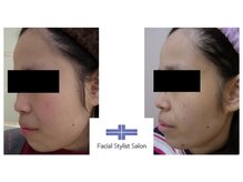 フェイシャルスタイリストサロン 高崎店(Facial Stylist Salon)/ケア例（46）