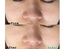 ちらちゅら/【施術直後の様子】