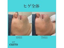 アクト クロ(ACT curro)/【ヒゲ全体】脱毛施術例