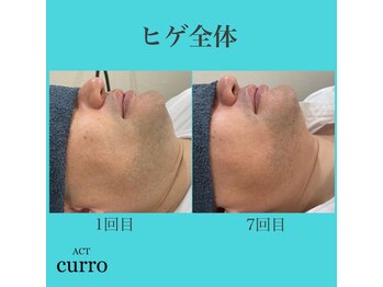 アクト クロ(ACT curro)/【ヒゲ全体】脱毛施術例