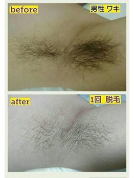 イズム(ism)/痛みが少なくお肌に優しい脱毛◎