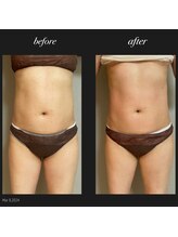 エヌボーテ(N. beaute)/お腹周りコース4回目