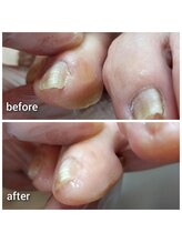 爪切り屋 足楽/趾どうしがくっつきあって