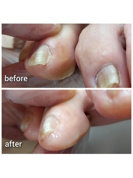 爪切り屋 足楽/趾どうしがくっつきあって