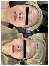 ジャスミン(Jasmin)/たるみ改善コース