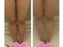 ヨサパーク ナナラーレア 福島店(YOSA PARK nanala lea)/ルルオン開始1ヶ月後【下半身】