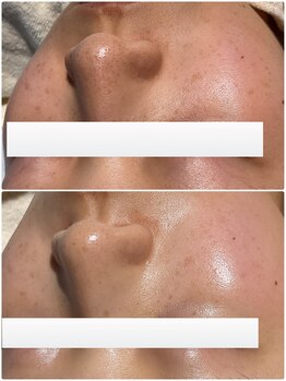 エクソ 吉祥寺(EXO)/スクライバーで毛穴洗浄