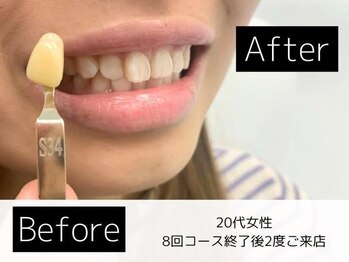 ホワイトニングカフェ 葛西店(WhiteningCafe)/◎歯のホワイトニング施術写真◎