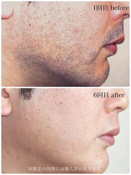 コモレビ(comorebi)/顔周り脱毛その２（経過画像）
