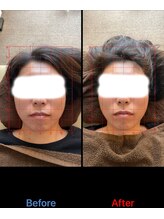 トーラス 整体(TORUS)/フェイスライン引き上げ