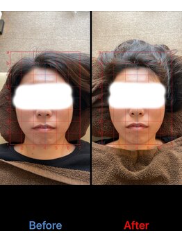 トーラス 整体(TORUS)/フェイスライン引き上げ