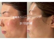 ライフサロン 別府(Life Salon)/ハーブピーリング/ララピール