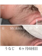 ミスターアンドミス 四ツ橋 堀江店(Mr.&Ms.)/レディースうなじ脱毛