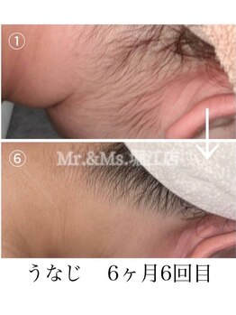 ミスターアンドミス 四ツ橋 堀江店(Mr.&Ms.)/レディースうなじ脱毛