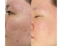 グラーティア(gratia)/エステ／肌改善