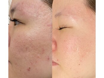 グラーティア(gratia)/エステ/肌改善