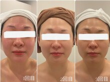 ユーフォリア グロウ(euphoria glow)/｛ &nbsp;骨入り小顔矯正 &nbsp;3回 &nbsp;｝