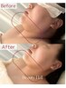 小顔＆水光【レッドショット脂肪分解剤2cc+エステダーマ】たるみ・引き締め