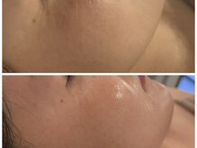 イディアル(IDE'AL)/陶肌トリートメント＋CYリキッド