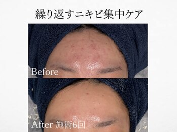 アンドミルル(and Milulu)/【繰り返すニキビ集中ケア】