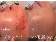 クオーレ 福津(cuore)の雰囲気（ブラックピーリングと毛穴ケアでニキビ改善◎）