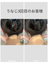 トッコ 清澄白河店(tocco)/うなじ脱毛