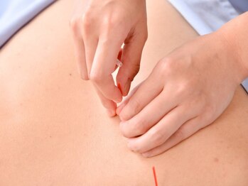 ゼロスポ鍼灸院 接骨院 上田の写真/肩こり・腰痛に局所アプローチ+姿勢矯正