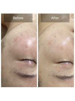 ダリア(Dahlia)/プラズマシャワー