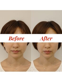 ジョア(joie)/美容鍼で小顔＆リフトアップ