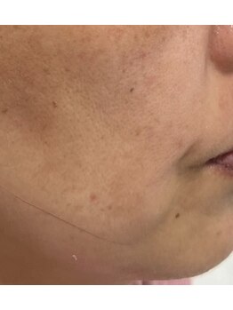 ピュアージュ/神技エイジング▼口元