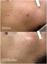 ジョアアンジェ 京橋店(joie ange)/クリスティーナ　ニキビケア