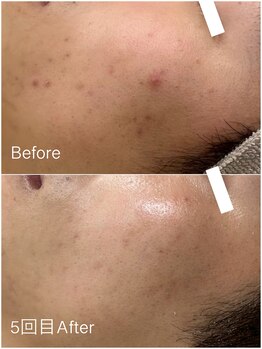 ジョアアンジェ 京橋店(joie ange)/クリスティーナ　ニキビケア