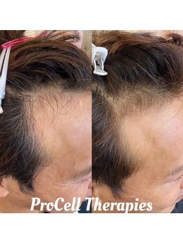 アイスブルー(Ice blue)/プロセルセラピーズBefore/After