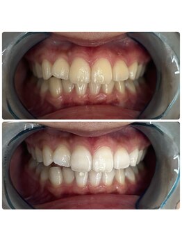 グリッター ショウナン(glitter. SHONAN)/藤沢ホワイトニングbefore/after