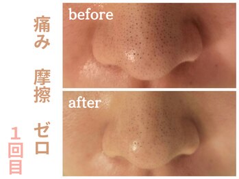 エリン(ERIN)/毛穴徹底洗浄　１回目