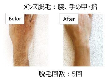オワゾーブルー(Oiseaubleu)/【メンズ】腕脱毛5回目