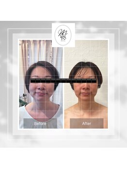 メグルサロン 自由が丘(MeguruSalon)/小顔矯正