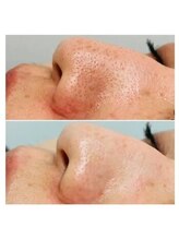 ラグラン銀座メディカルエステ 高輪ゲートウェイ店/ 自分史上☆超絶最強の美白に!!