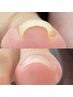 【器具を使わない巻き爪補正】痛みを抑えて自然な見た目に◎ 親指1本 
