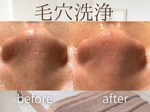 ラグレ(LUXRE)/ハイドロ毛穴洗浄