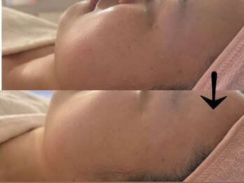 サロン ドロップ 上小田井(Salon drop)/「シミ改善」